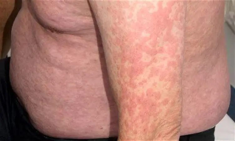Visualisasi Ruam Maculopapular HIV tampilan visual maculopapular rash pada dada penderita HIV