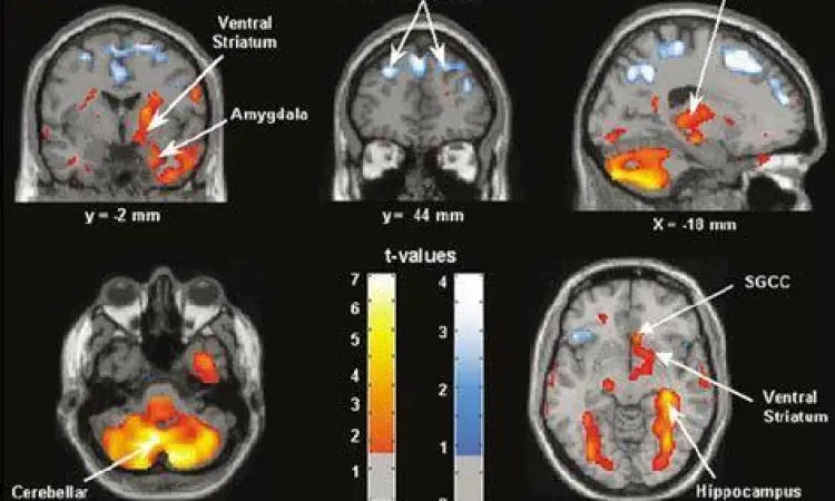 Perbandingan pemindaian otak penderita bipolar