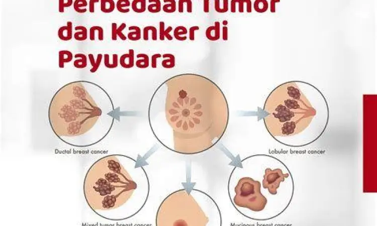 Infografis jenis tumor jinak pada payudara