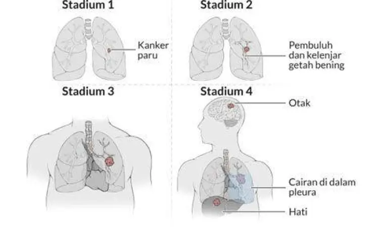 Ilustrasi gejala kanker paru paru pada dada manusia