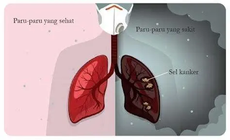Anatomi Kanker Paru Paru Perbandingan paru paru sehat dan paru paru yang terkena kanker
