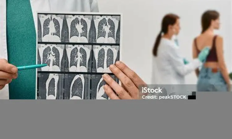 Prosedur CT Scan untuk deteksi dini kanker paru