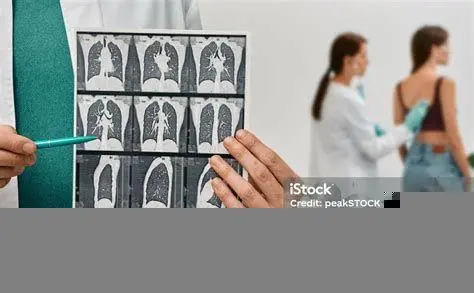 Deteksi Dini Kanker Paru Paru Prosedur CT Scan untuk deteksi dini kanker paru