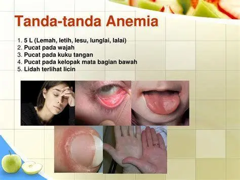 Gejala Umum Anemia Ilustrasi gejala anemia seperti lemas dan pucat