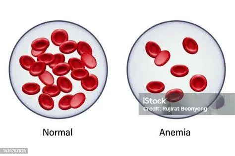 Struktur Sel Darah Perbandingan sel darah merah normal dan anemia