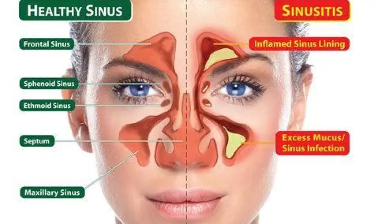 Titik nyeri pada wajah akibat sinusitis