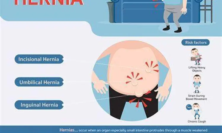 Gejala Visual Hernia Visualisasi gejala benjolan pada perut akibat hernia