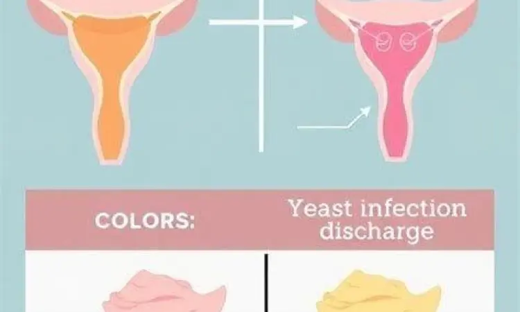 Infeksi Jamur Vagina Perbandingan keputihan akibat infeksi jamur
