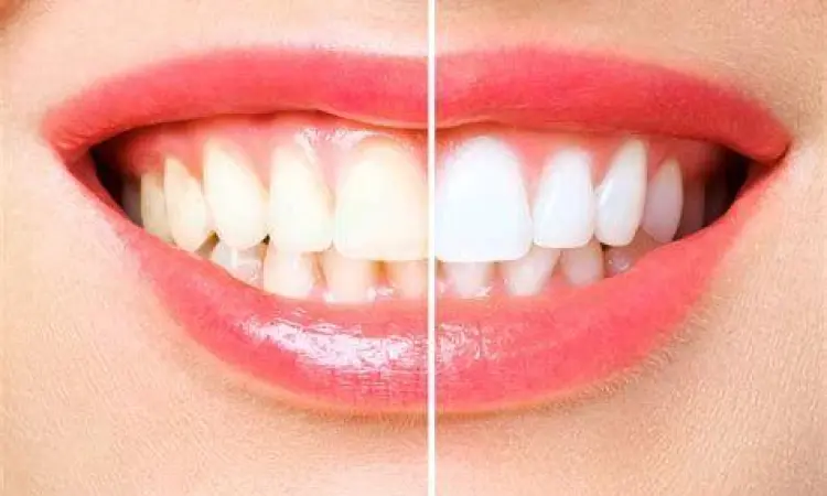 Prosedur bleaching gigi di klinik