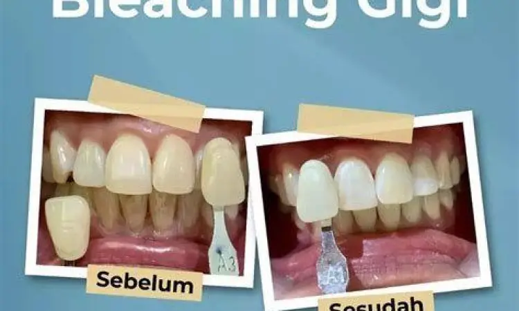 Ilustrasi gigi sensitif terhadap suhu panas dan dingin