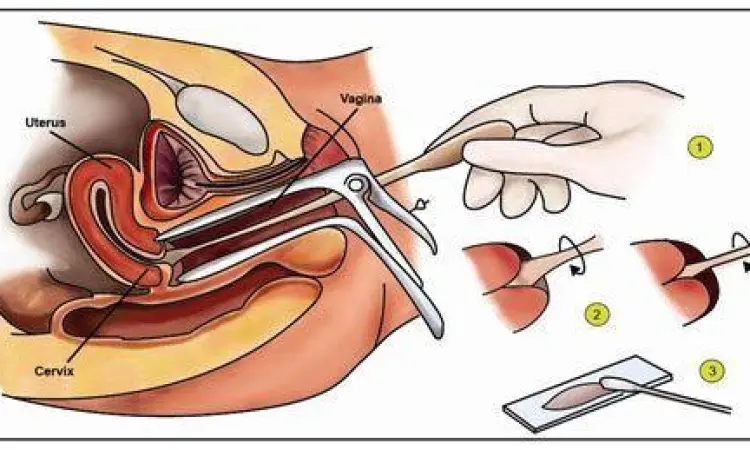 Lokasi Pengambilan Sampel Pap Smear Anatomi serviks dan lokasi pengambilan sampel pap smear
