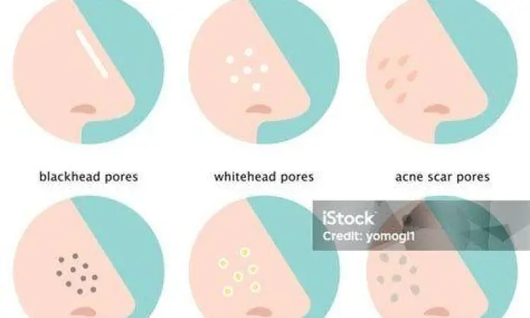 Ilustrasi penyumbatan pori-pori pada area hidung