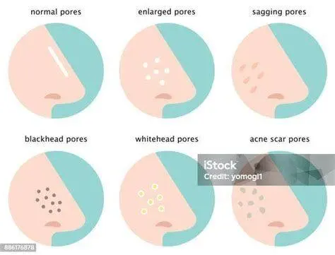 Anatomi Pori-Pori Hidung Ilustrasi penyumbatan pori-pori pada area hidung