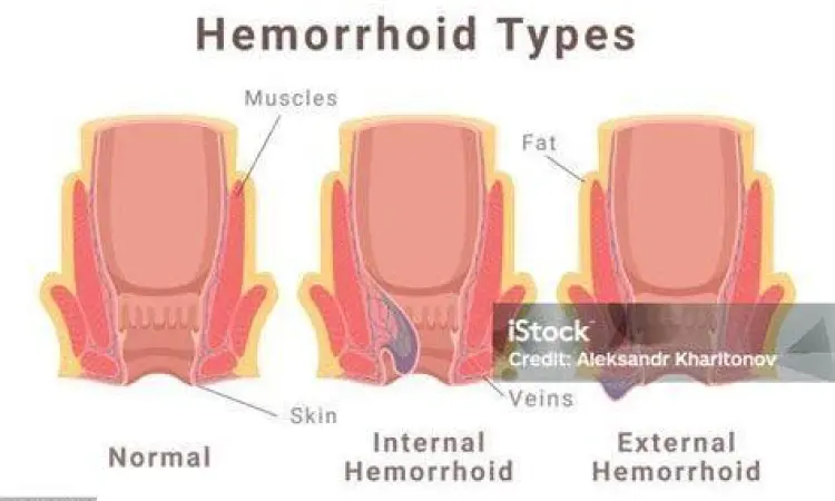 Anatomi Ambeien Diagram anatomi ambeien internal dan eksternal