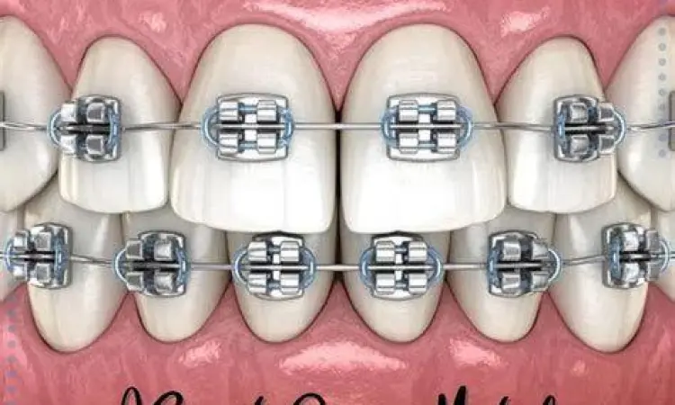 Kawat Gigi Metal Tradisional Proses pemasangan kawat gigi metal oleh spesialis