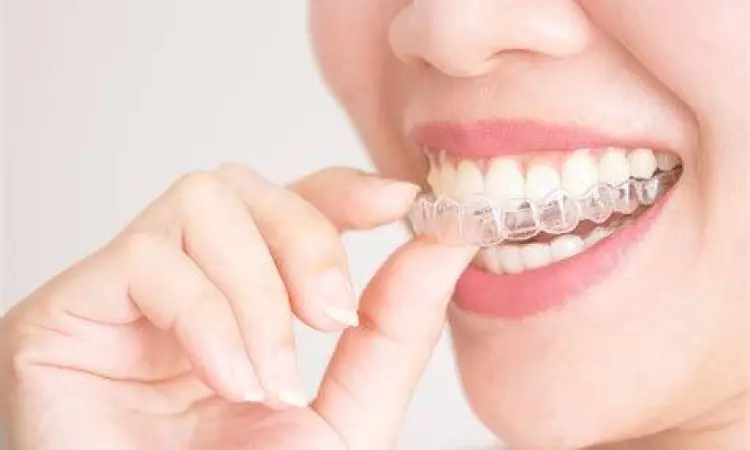 Clear Aligners Modern Aligner transparan untuk merapikan gigi