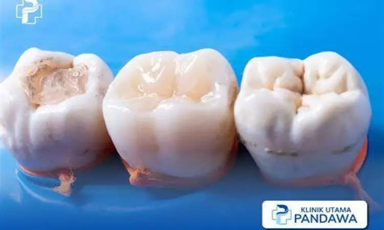 Pilihan Bahan Tambal Gigi Perbandingan bahan tambal gigi logam dan komposit