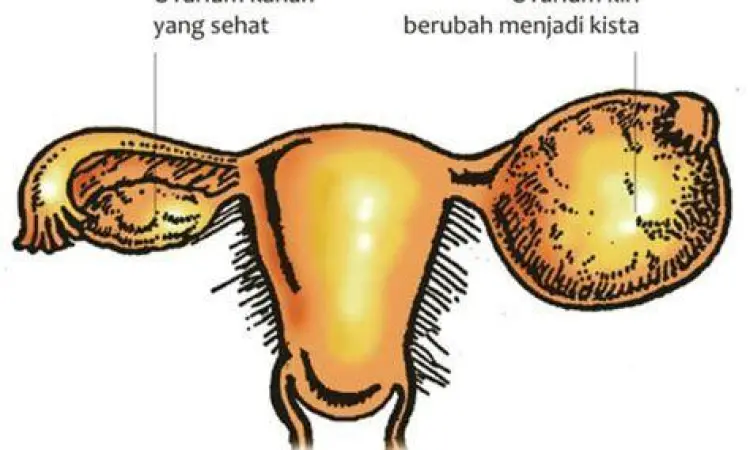 Visualisasi Kista Ovarium Anatomi kista ovarium pada sistem reproduksi wanita