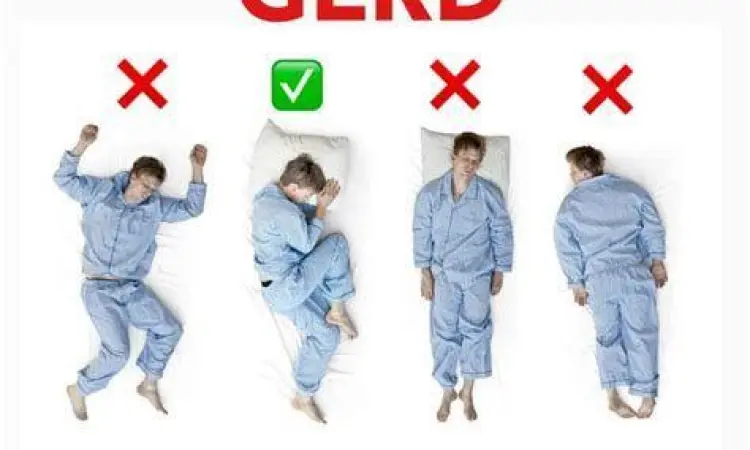 Posisi tidur miring kiri untuk penderita GERD