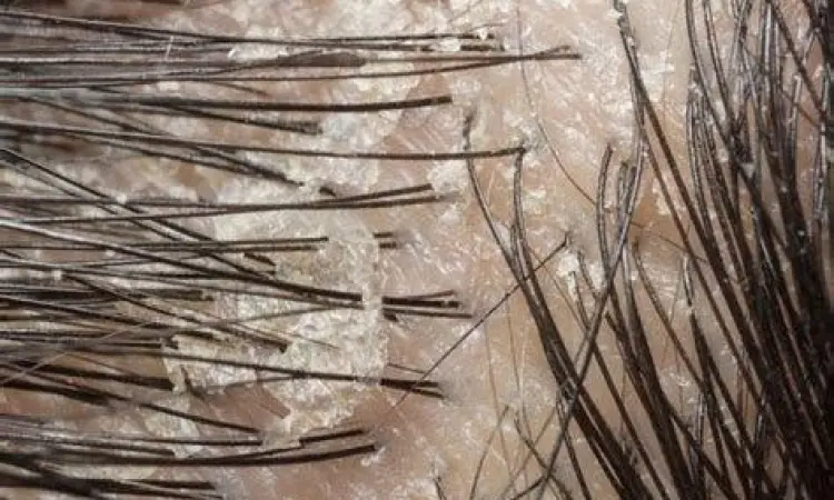 Mikroskopis jamur Malassezia pada kulit kepala