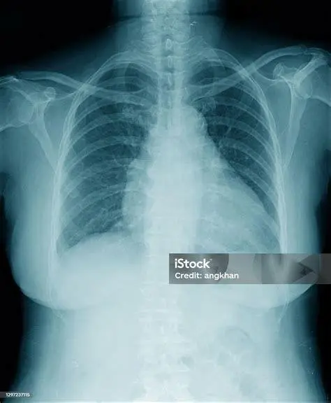 Diagnosis Rontgen Paru Hasil rontgen dada menunjukkan area putih yang mengindikasikan infeksi