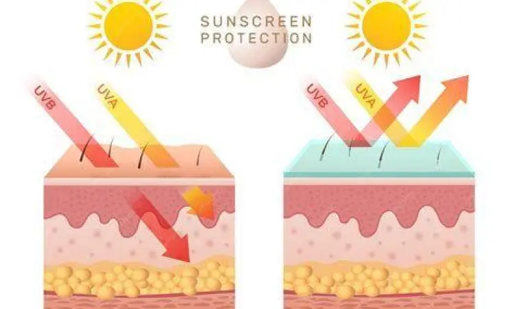 Ilustrasi kerusakan kulit akibat sinar UV