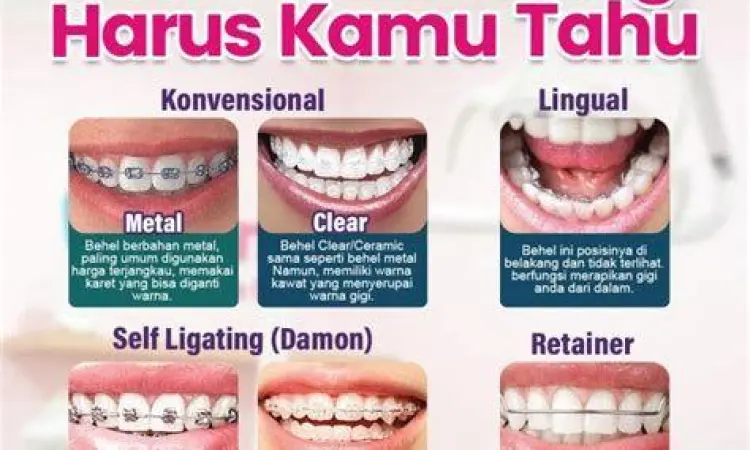 Perbandingan jenis kawat gigi metal keramik dan damon