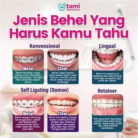 Jenis-Jenis Behel Gigi Perbandingan jenis kawat gigi metal keramik dan damon