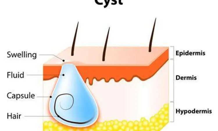 Diagram anatomi pertumbuhan kista