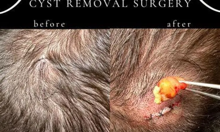 Prosedur Bedah Kista Prosedur operasi pengangkatan kista