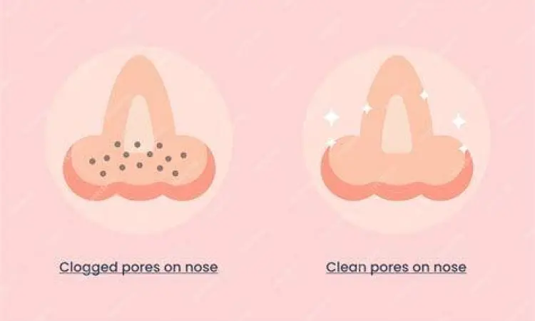 Mekanisme Pembersihan Pori Diagram perbandingan pori-pori tersumbat dan pori-pori bersih setelah eksfoliasi