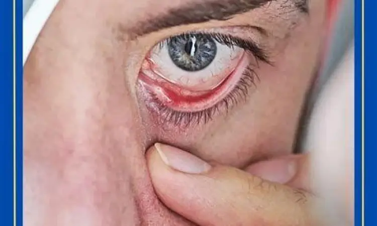 Risiko Steroid Mata Risiko penggunaan jangka panjang steroid mata