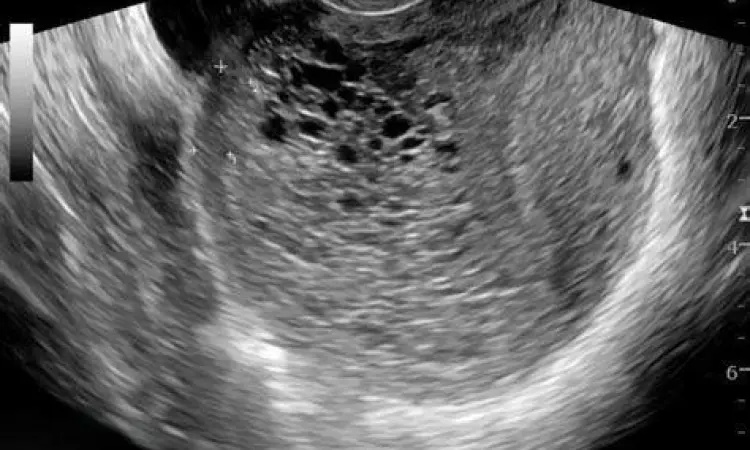 Gejala fisik dan visual mola hidatidosa