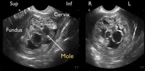 Pemeriksaan Diagnostik Hamil Anggur Hasil pemeriksaan USG menunjukkan gambaran badai salju pada hamil anggur