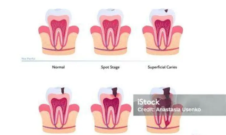 Proses Kerusakan Gigi Anatomi gigi yang mengalami karies hingga ke pulpa