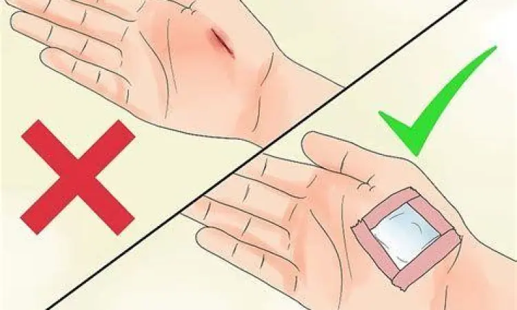 Cara melepas plester luka tanpa sakit
