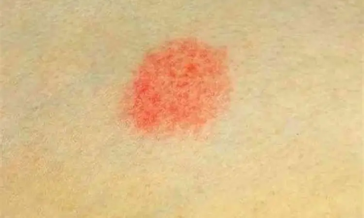 Gejala ruam merah yang membutuhkan salep gatal kulit