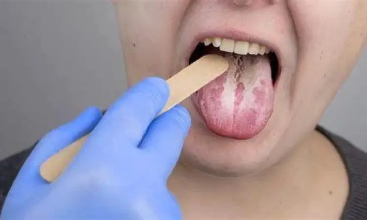 Risiko Oral Thrush Efek samping jamur mulut akibat penggunaan steroid