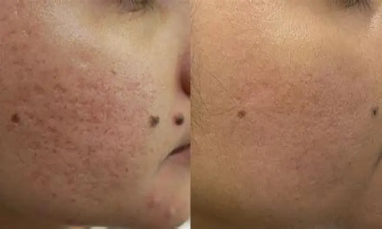 Prosedur laser fractional CO2 untuk bopeng