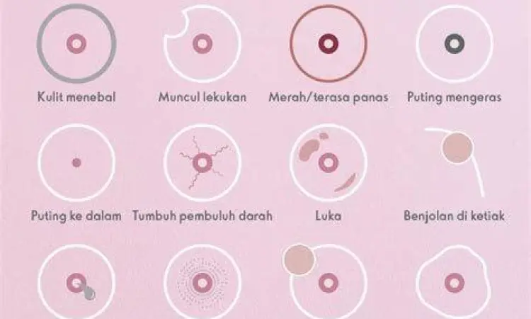 Gejala Visual Kanker Payudara Ilustrasi benjolan dan perubahan fisik payudara