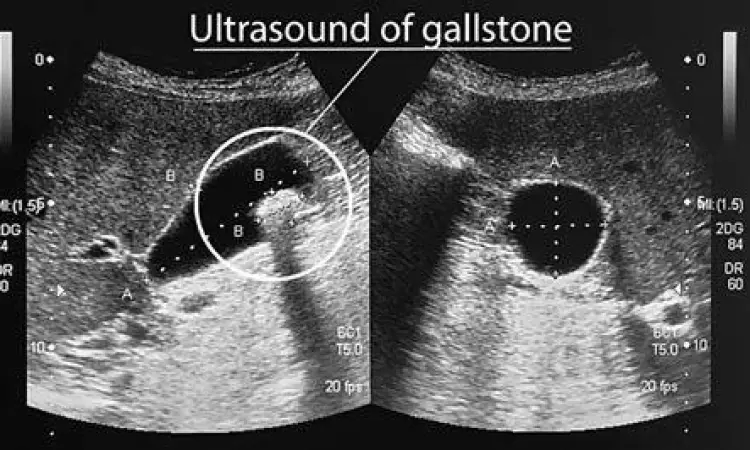 Hasil pemeriksaan USG batu empedu