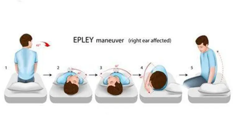 Teknik manuver Epley untuk mengatasi BPPV