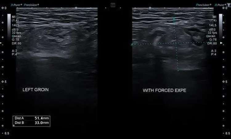 Prosedur USG selangkangan untuk diagnosis