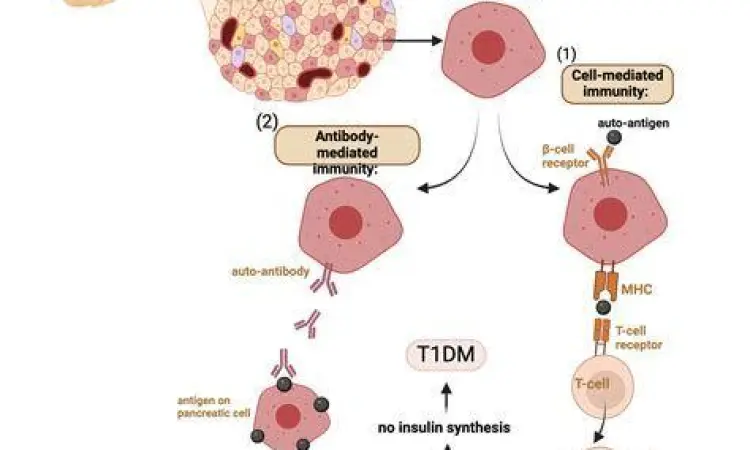 Ilustrasi sel beta pankreas yang diserang sistem imun