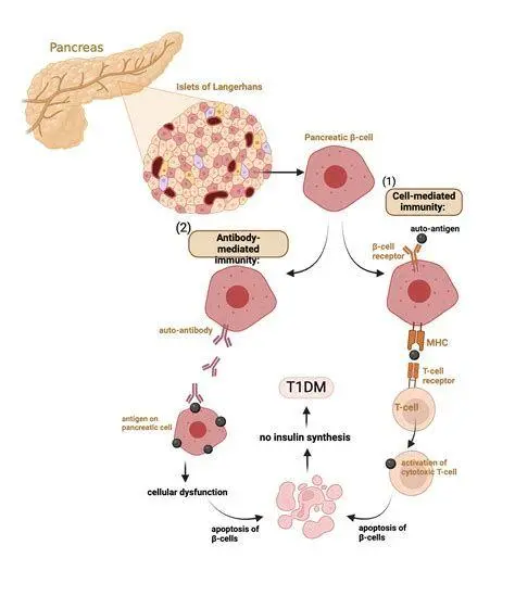 Kerusakan Sel Beta Pankreas Ilustrasi sel beta pankreas yang diserang sistem imun