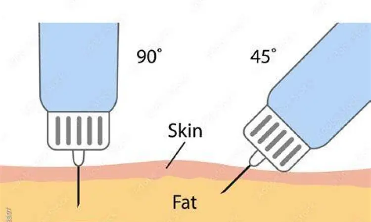Teknik penyuntikan insulin yang benar pada perut