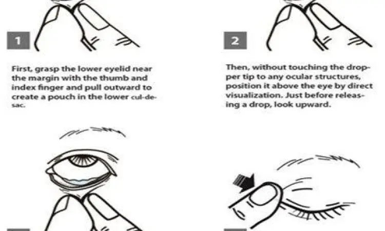 Teknik Aplikasi Tetes Mata Langkah menggunakan tetes mata yang higienis