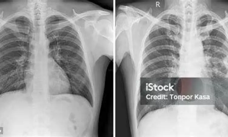 Perbandingan rontgen dada sehat dan rontgen dada penderita pneumonia