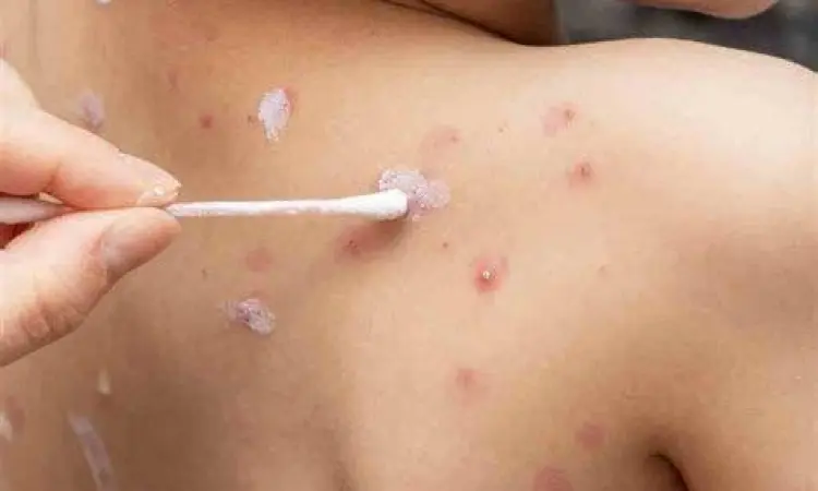 Cara mengoleskan salep cacar air dengan benar