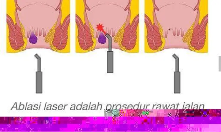 Prosedur operasi ambeien modern
